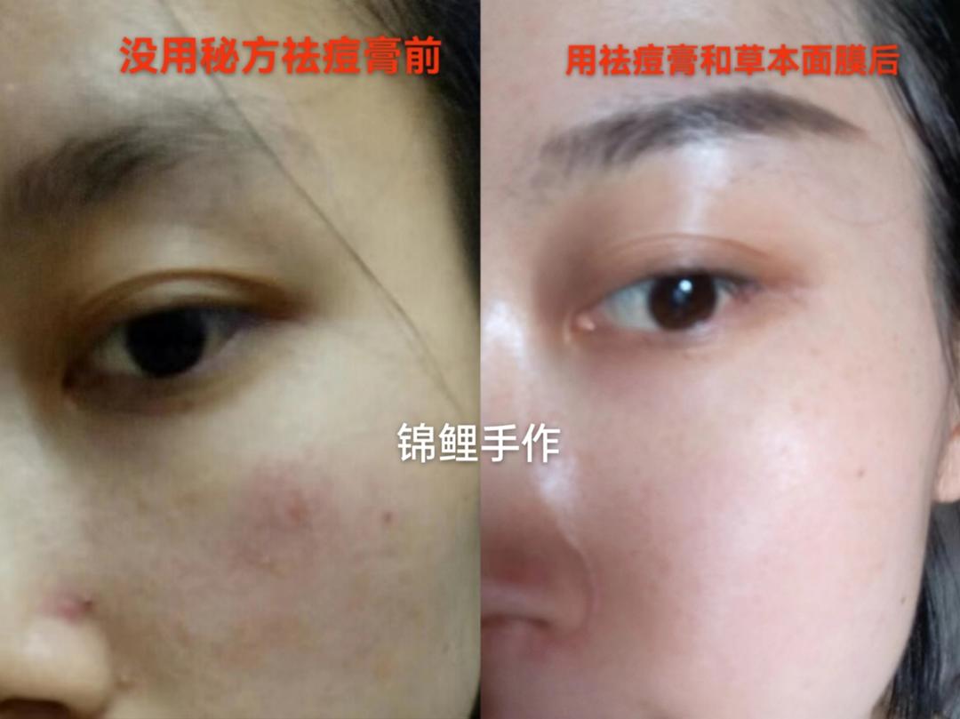 秘方草本祛痘棒，青春痘，后背痘，痘印等