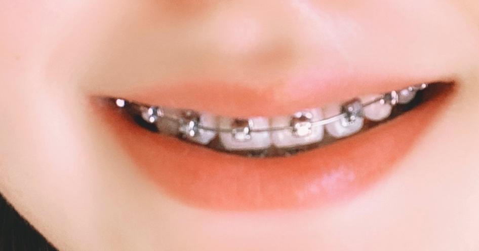 牙套饮食、正畸餐