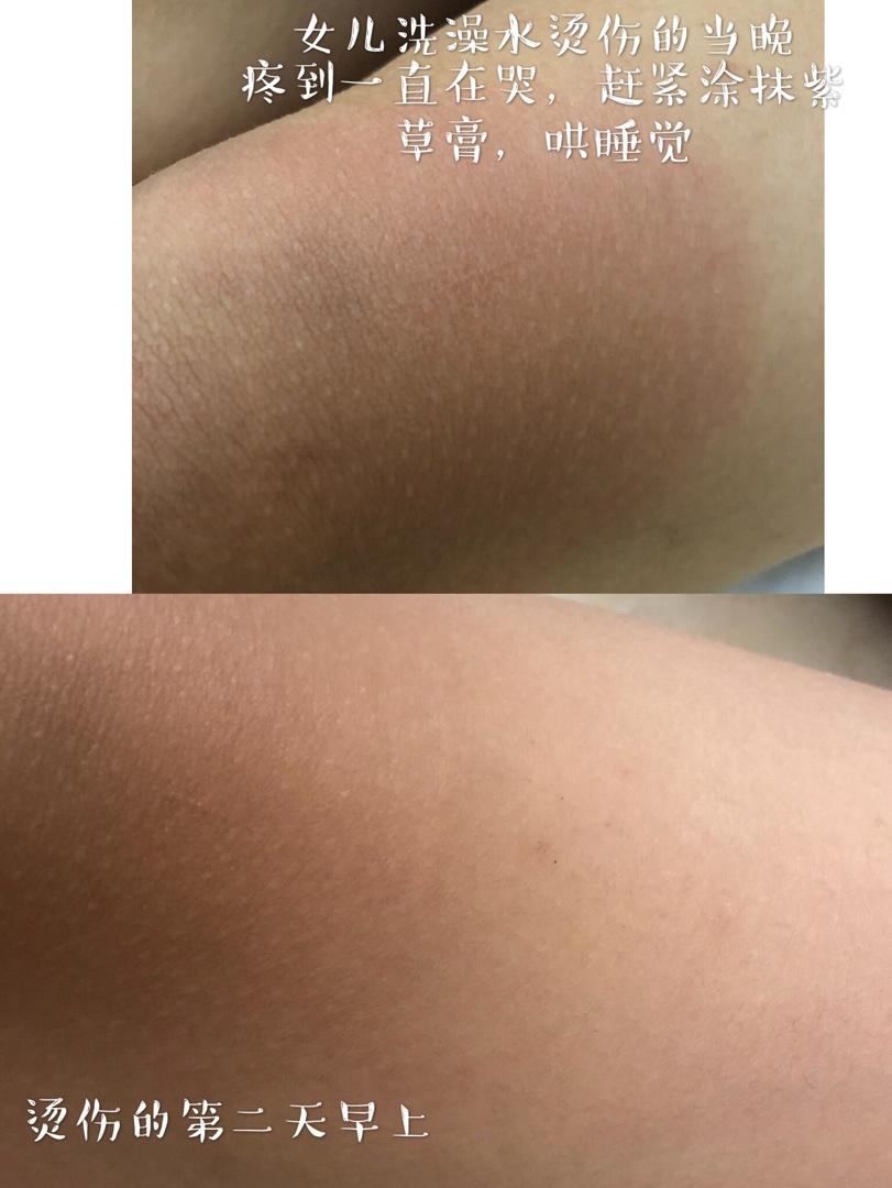 今夏风靡我盆友圈的紫草膏